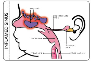 graph of inflamed sinus system in young child